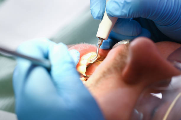 Best Emergency Dentist for Lost Fillings or Crowns in Yacolt, WA